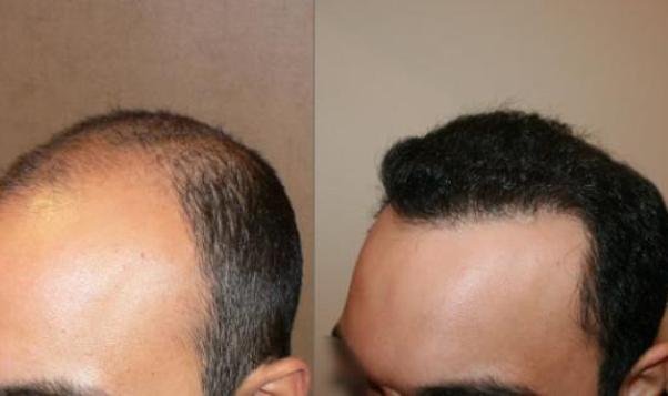 Hair transplant to get rid from the hair loss problems Hair transplant to get rid from the hair loss problems