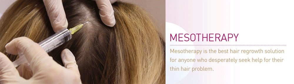 Mesotherapy-For-Hairloss