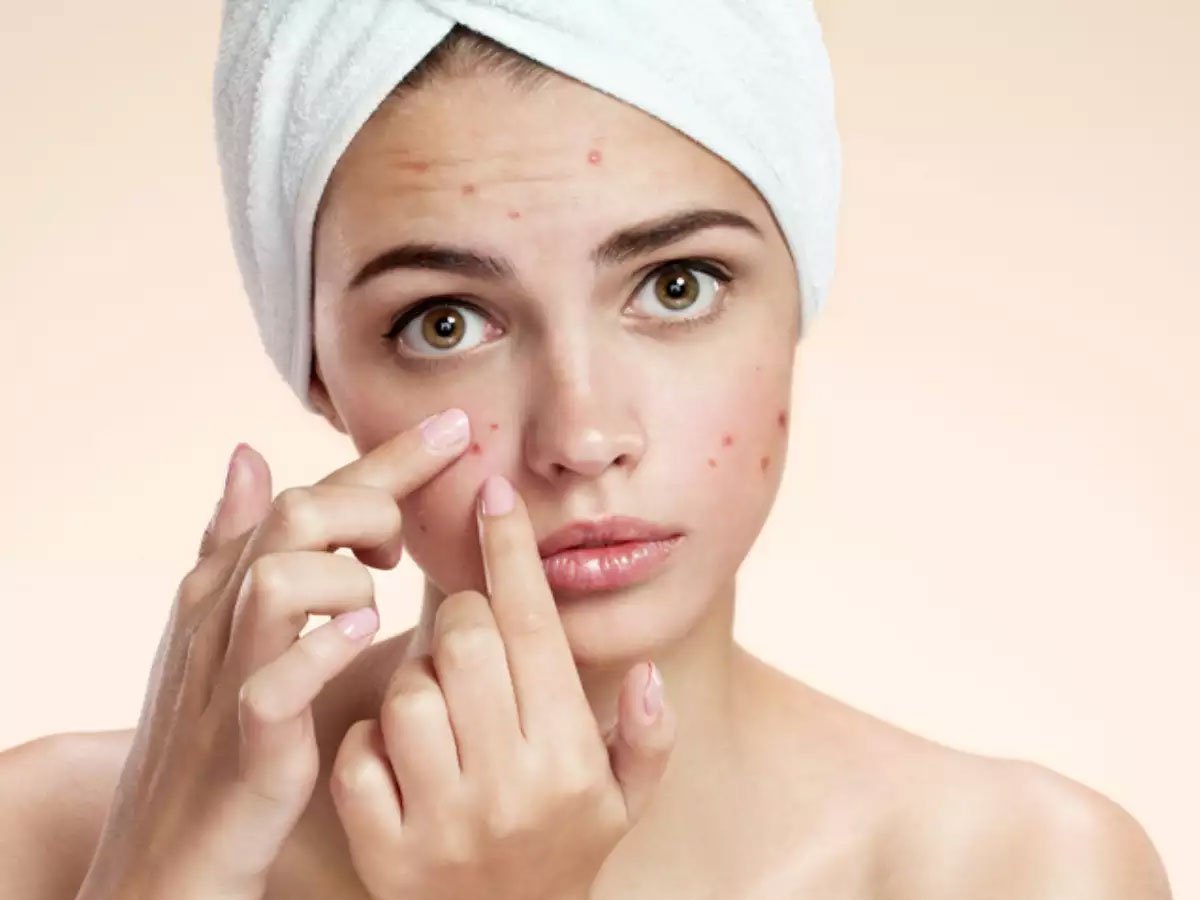 Acne Treatment In Lucknow