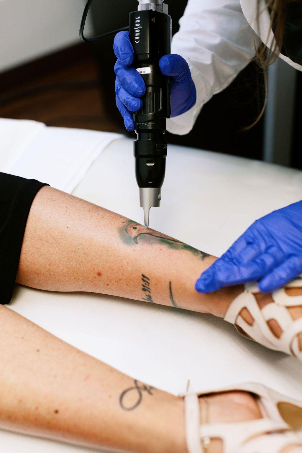 best tattoo removal in lucknow