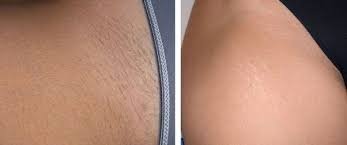 Bikni Line Laser hair Removal in Lucknow Bikni Line Laser hair Removal in Lucknow