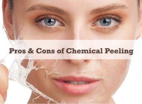 What is chemical peeling?