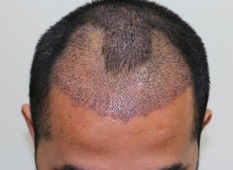 Reasons Why Hair Transplant Is Gaining More Popularity