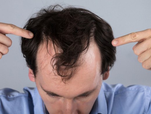 Hairfall , a permanent ailment or is there any solid solution to this issue 