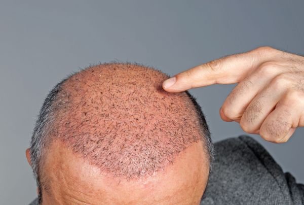 Why Is Hair Transplant Famous