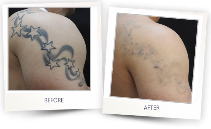 Laser tattoo removal in Lucknow
</div>
</div>
</div>
</div></div>
<div class= Laser tattoo removal in Lucknow