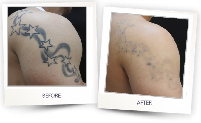 The best tattoo removal process  Lasermed Laser Clinic  facial  rejuvenation