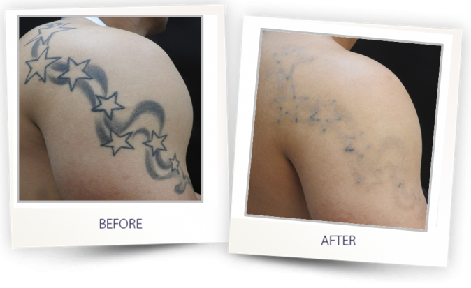 Laser tattoo removal in Lucknow
</div>
</div>
</div>
</div></div>
<div class= Laser tattoo removal in Lucknow