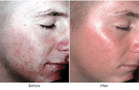 How Laser Skin Resurfacing Work  