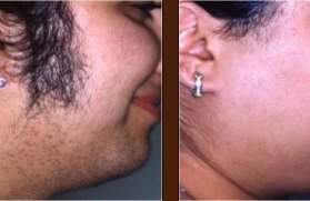 Laser hair removal work Tattoo Removal in Lucknow