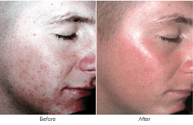 How Laser Skin Resurfacing Work Acne Treatment In Lucknow
