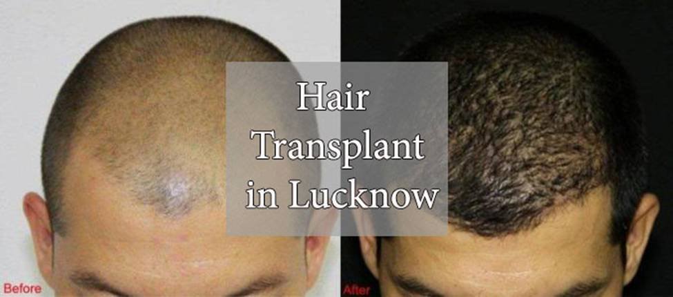 10 Reasons to Choose FUE Hair Transplant Treatment  ALCS  Cosmetic  Surgery  Hair Transplant In Jaipur