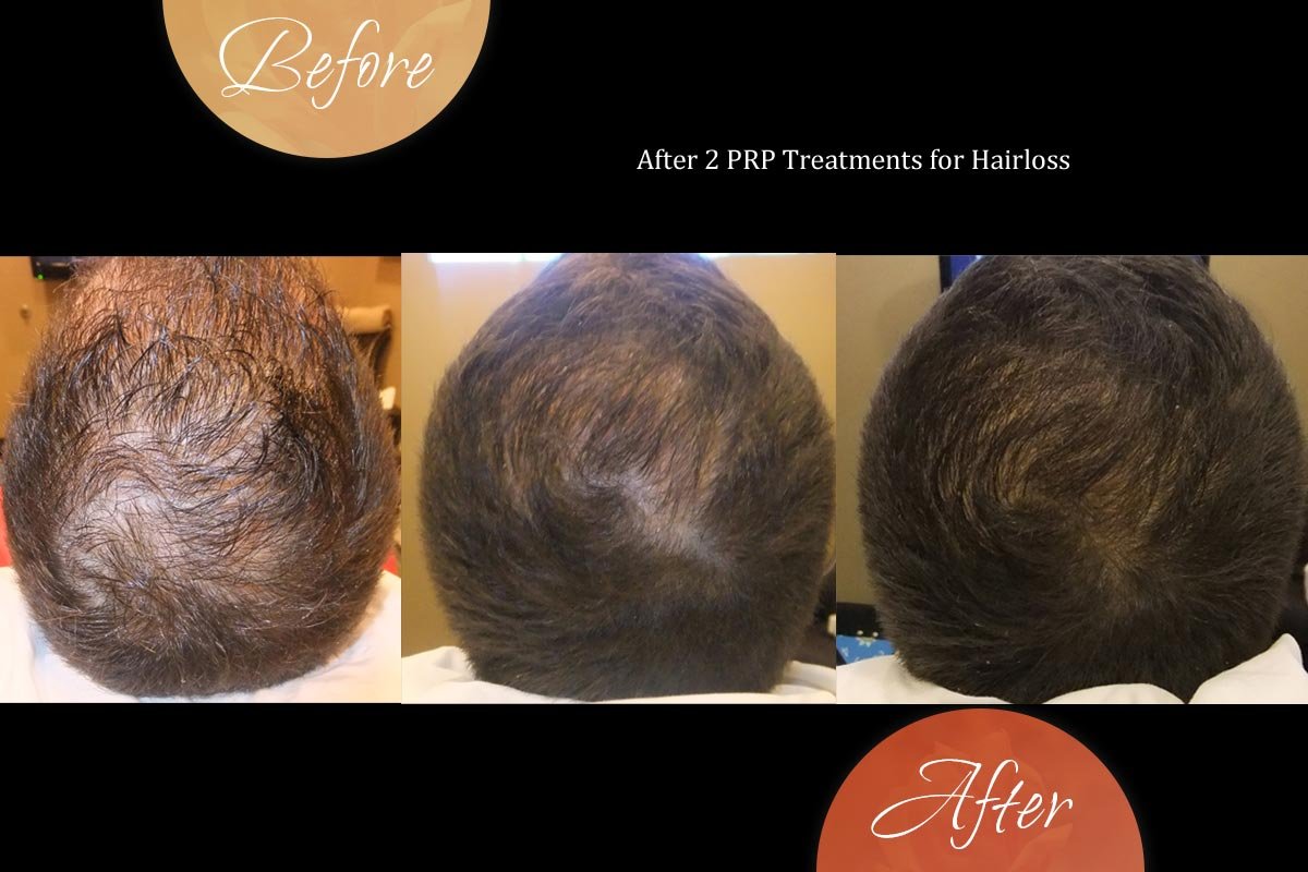 PRP Treatment In Lucknow PRP Treatment In Lucknow