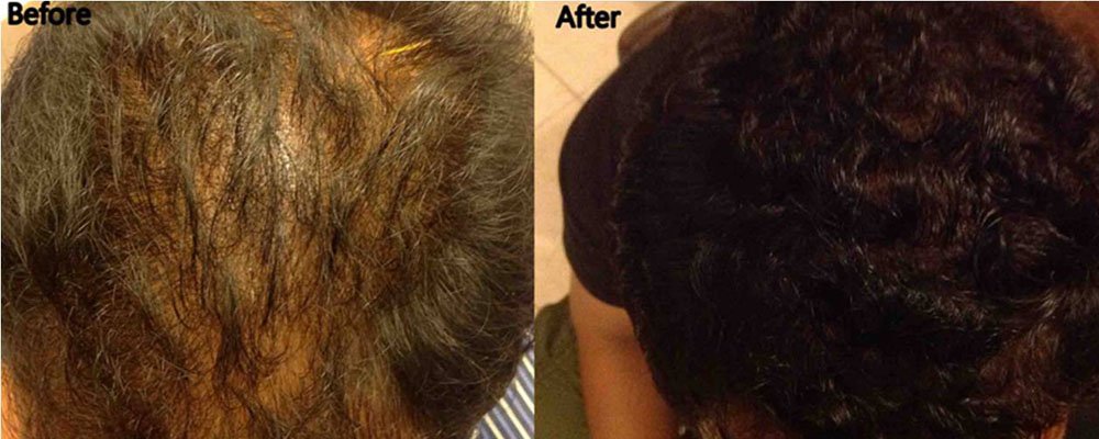 Stem Cell Therapy in Lucknow
