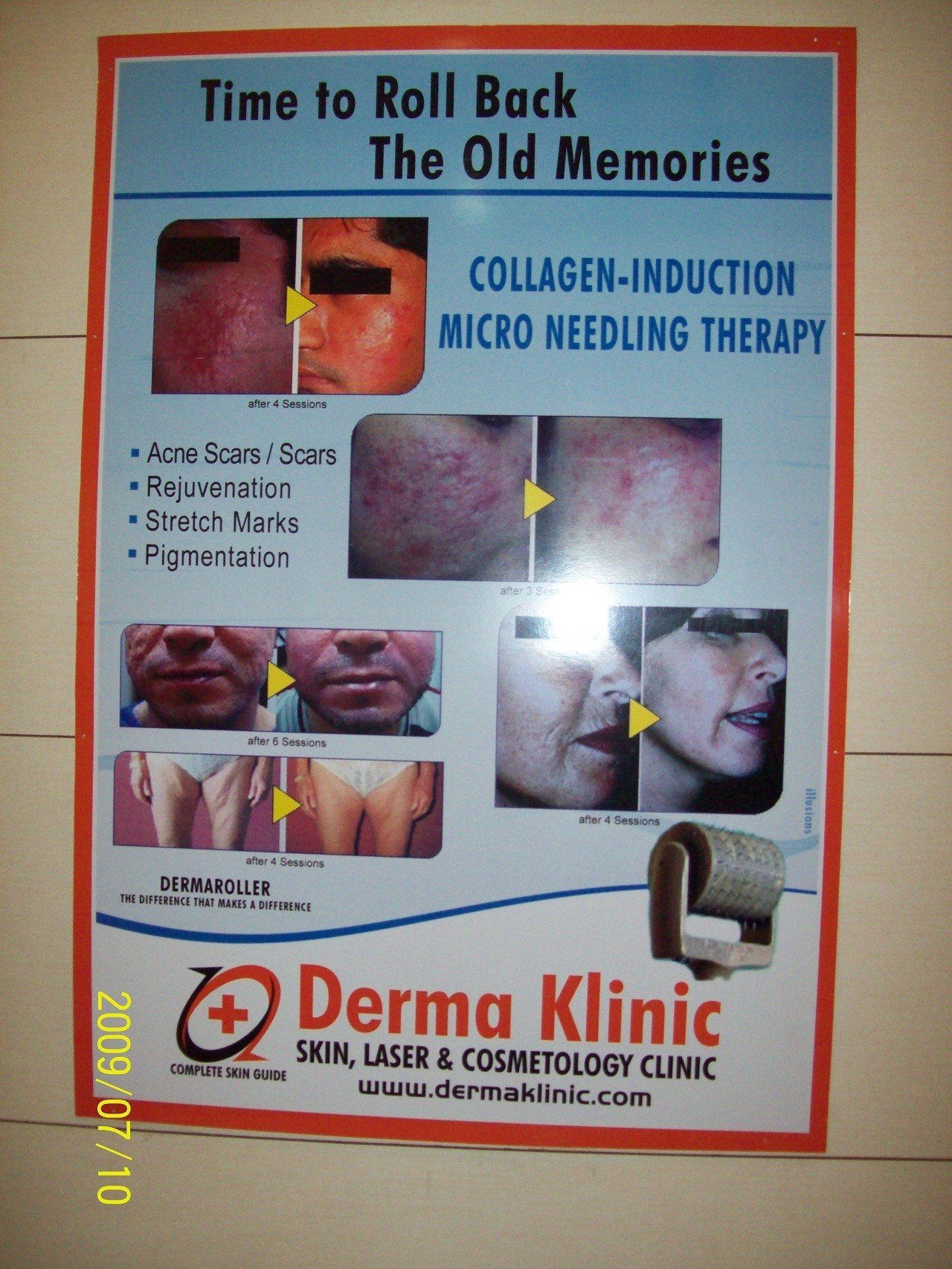 Laser tattoo Removal in lucknow