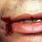 Stem Cell Therapy In Lucknow