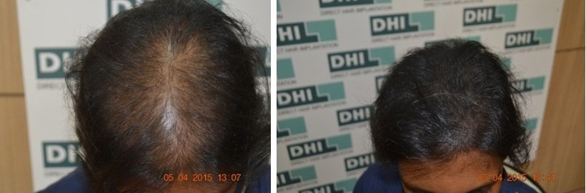 Face Treatment in Lucknow
