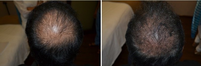 Face Treatment in Lucknow