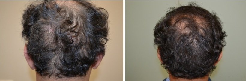 Face Treatment in Lucknow