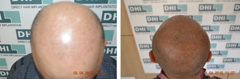 Face Treatment in Lucknow