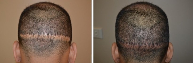 Face Treatment in Lucknow