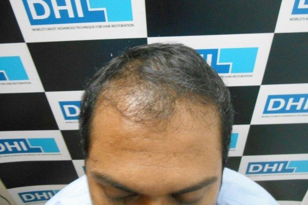 Peels Treatment In Lucknow