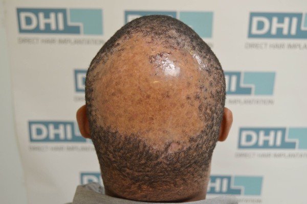 Peels Treatment In Lucknow