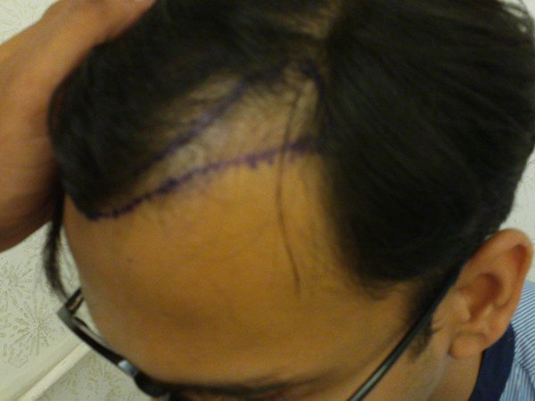 Laser Hair Reduction In Lucknow