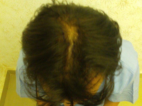 Peels Treatment In Lucknow