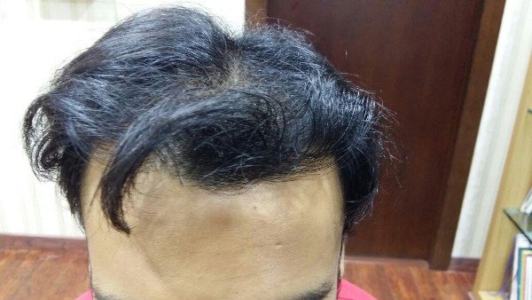 Peels Treatment In Lucknow