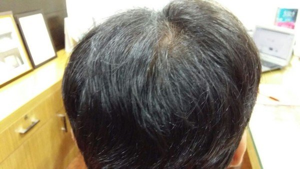 Peels Treatment In Lucknow