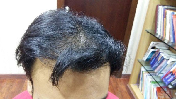 Peels Treatment In Lucknow